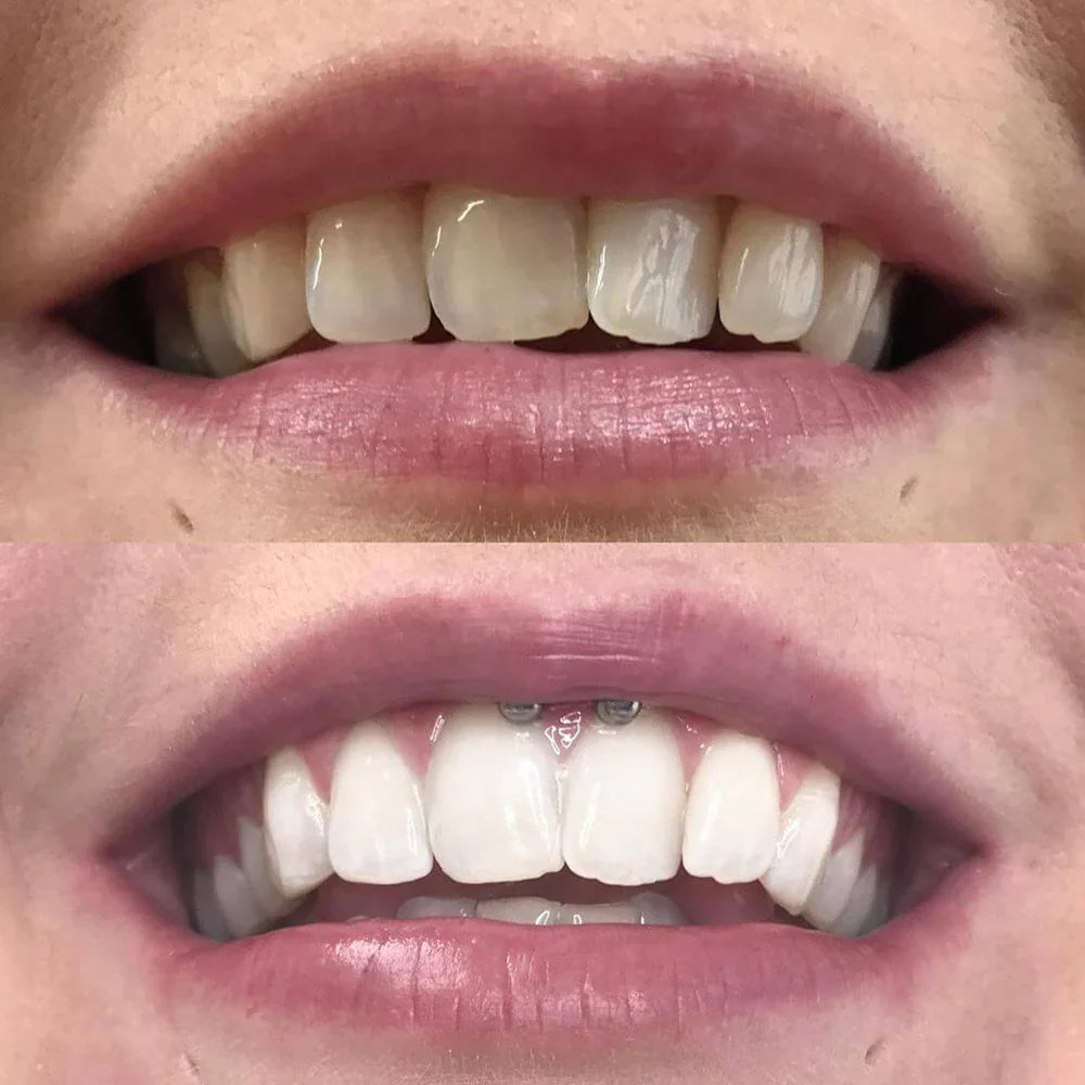 Color Correction Teeth Whitening Pen