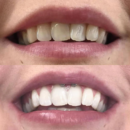 Color Correction Teeth Whitening Pen